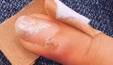 Nos Estados Unidos, mulher desenvolve câncer de pele depois de ter ido a manicure (Reprodução/TikTok)